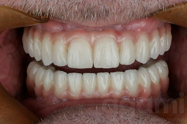 Тотальное восстановление зубных рядов