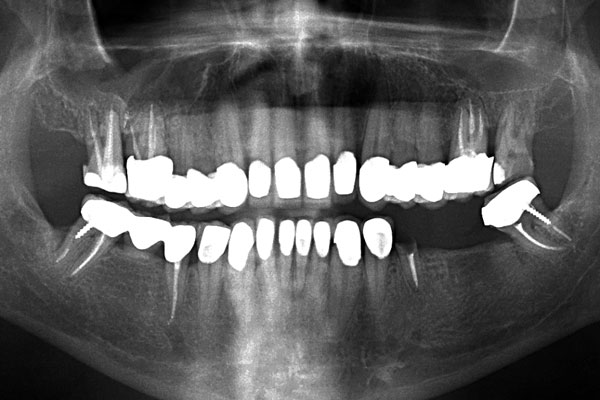 Имплантация зубов (рентген)