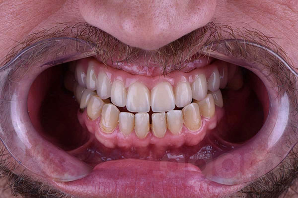 Восстановление зубного ряда верхней челюсти с помощью имплантации All-on-4