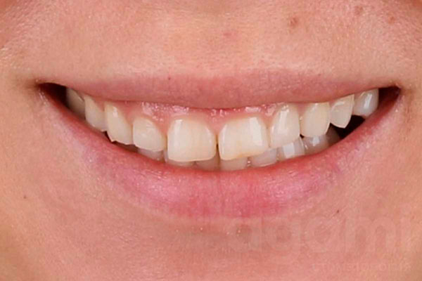 Коррекция улыбки при помощи имплантации и протезирования винирами
